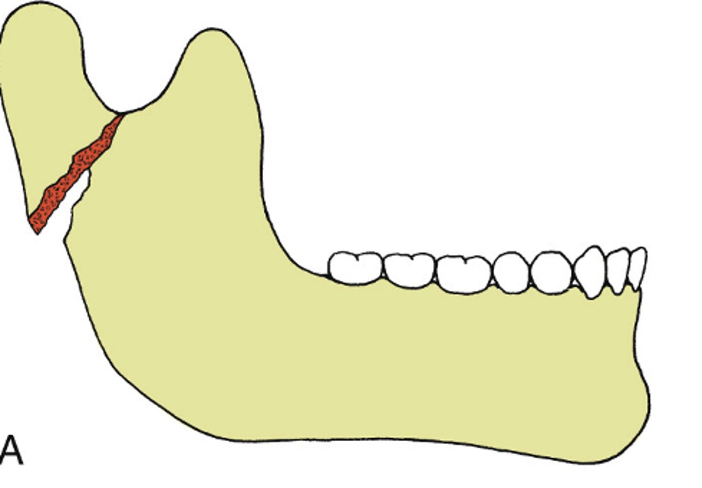 <p>ID the type of mandibular fracture:</p><p>•an incomplete fracture</p><p>•Typically in soft, flexible bone, often in children</p><p>•No mobility (both cortices are not fractured)</p>