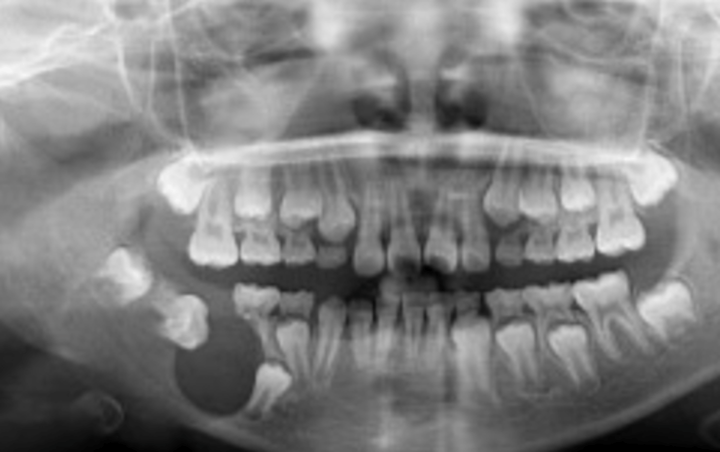 <p>common in younger patients</p><p>they mimic dentigerous cysts</p><p>xray- unilocular radiolucency (less invasive)</p>