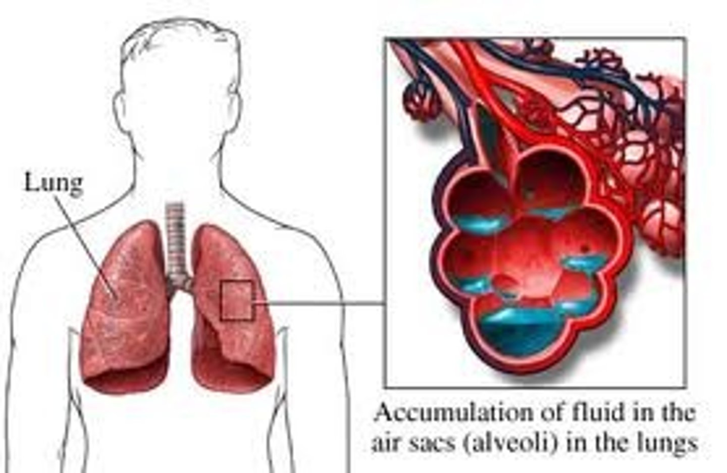 <p>fluid accumulation in the alveoli and bronchioles, most often a manifestation of heart failure</p>