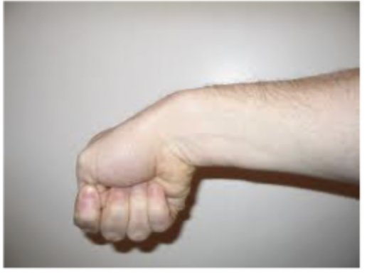 <p>45 male presents to the clinic for wrist pain that worsens when grabbing objects. On physical exam you note tenderness at the level of the radial styloid, pain with resisted deviation, and a positive finkelstein test. X-rays are negative. What is your non-op treatment?</p>