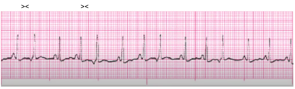 <p>treat the underlying cause (stimulants, heart disease, electrolyte imbalance, fatigue)</p>