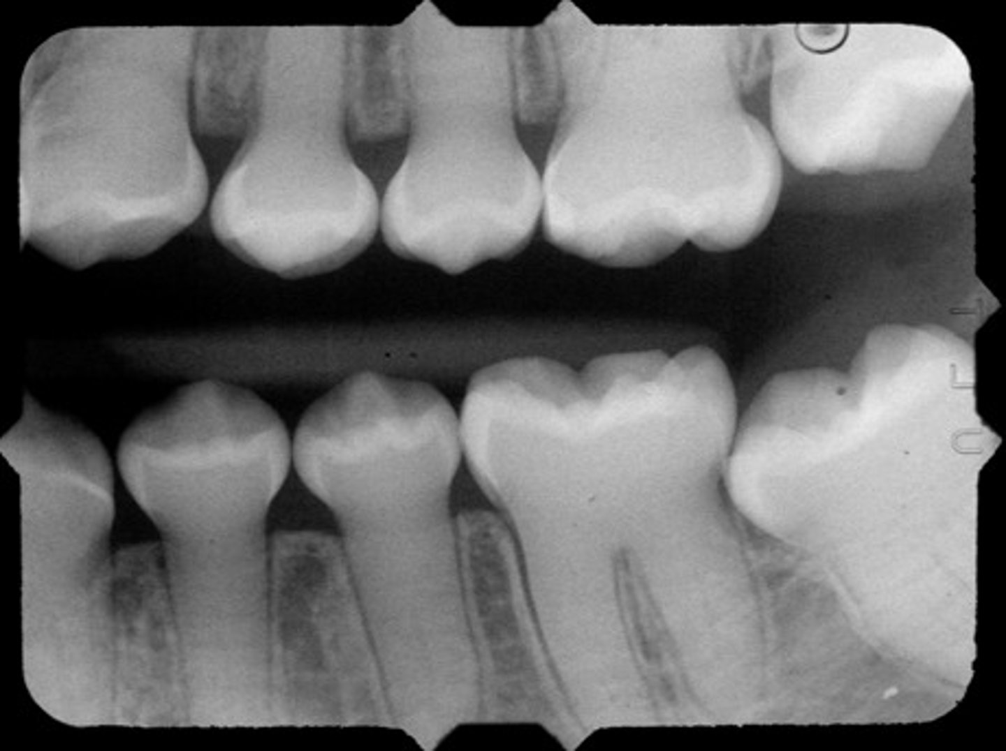 <p>- bulbous crowns</p><p>- cervical constriction</p><p>- thin roots</p><p>- early obliteration of root canals and pulp chambers</p>