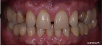 <p>Aging (dystropic calcification)</p>
