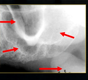 <p>edentulous patient </p><p>can see u shaped edge of hollowed out zygomatic bone </p>