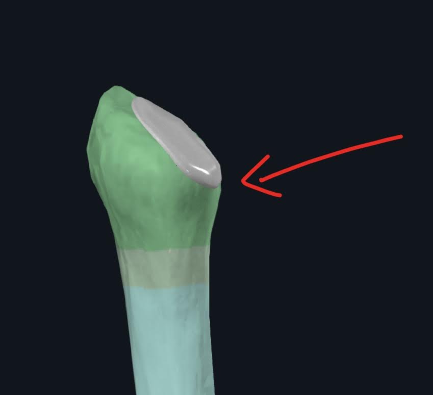 <p>1)Se encuentra en el extremo superior de la fíbula, superior a un cuello pequeño</p><p>2)Esta se articula con la cara fibular de la parte inferior, posterolateral del cóndilo lateral de la tibia</p>