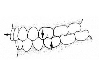 <p>Class II</p>