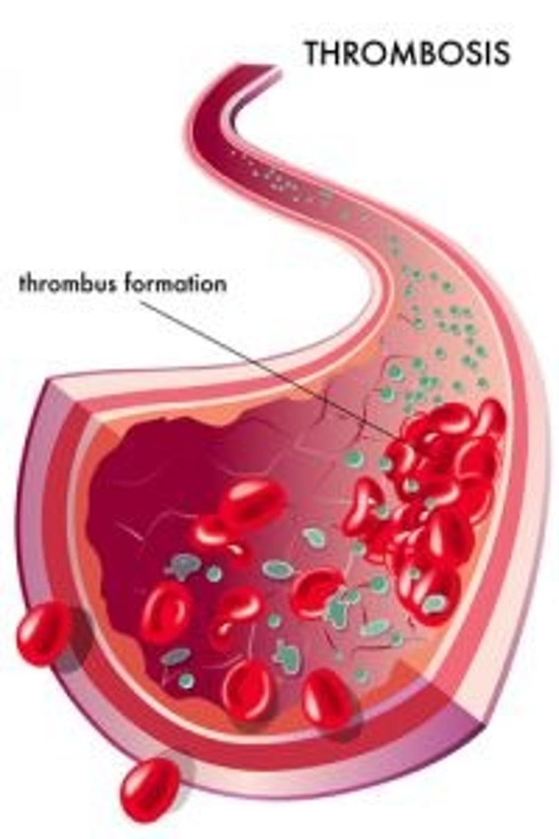 <p>A blood clot that forms in an artery</p>