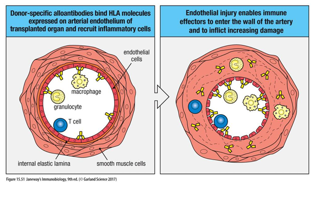 <ul><li><p>Rejection of matched organs can occur years after transplant. </p></li><li><p>The mechanism is obscure but may relate to immune response against blood vessels. The blood supply to the organ is compromised, resulting in ischemia and loss of function. </p></li><li><p>Chronic rejection may be due to type III hypersensitivity due to IgG antibodies against allogeneic HLA class I on graft, forming immune complexes that deposit in the blood vessels of transplant. </p></li><li><p>Also, indirect allo recognition is important for chronic rejection as B cells binding donor HLA proteins are ‘helped’ by T cells. </p></li><li><p>Kidney damage can also affect loss by non-immune mechanisms.</p></li></ul><p></p>