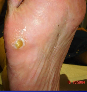 <p><span><strong>[What demographic]</strong></span> often have</p><ul><li><p>Verrucae (painful wart)&nbsp;</p></li><li><p>IGTNs (ingrown toenail)</p></li></ul><p></p>