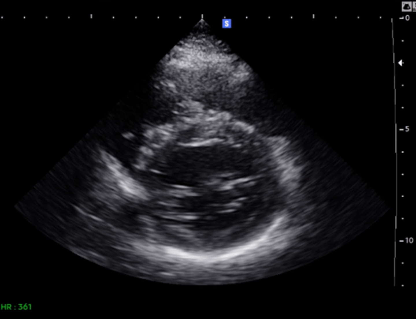 <p>anterior mitral valve leaflet</p>