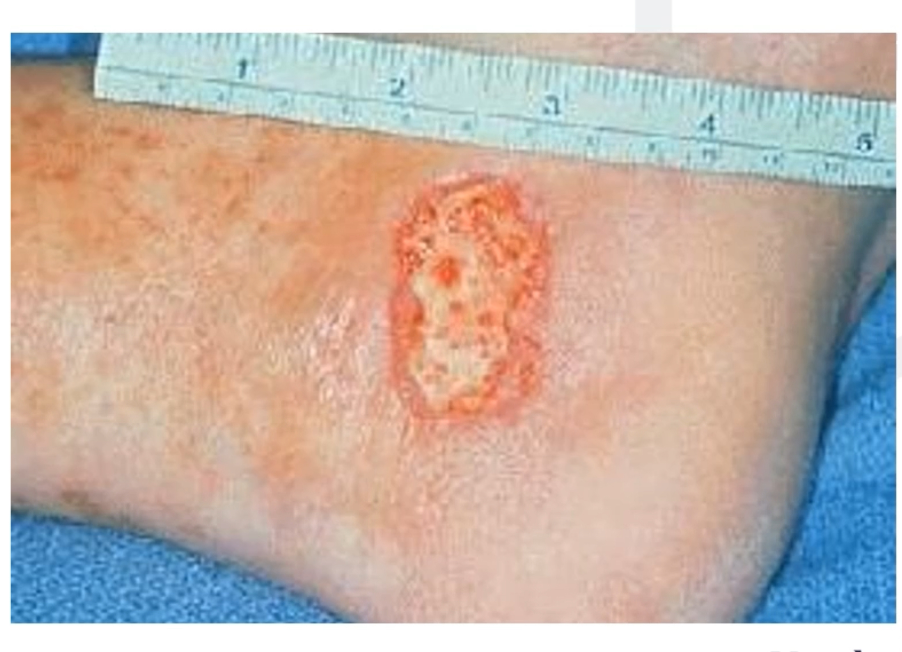 <p>Not great blood supply so may not be fully restored, takes a while to heal and is very difficult to heal </p>