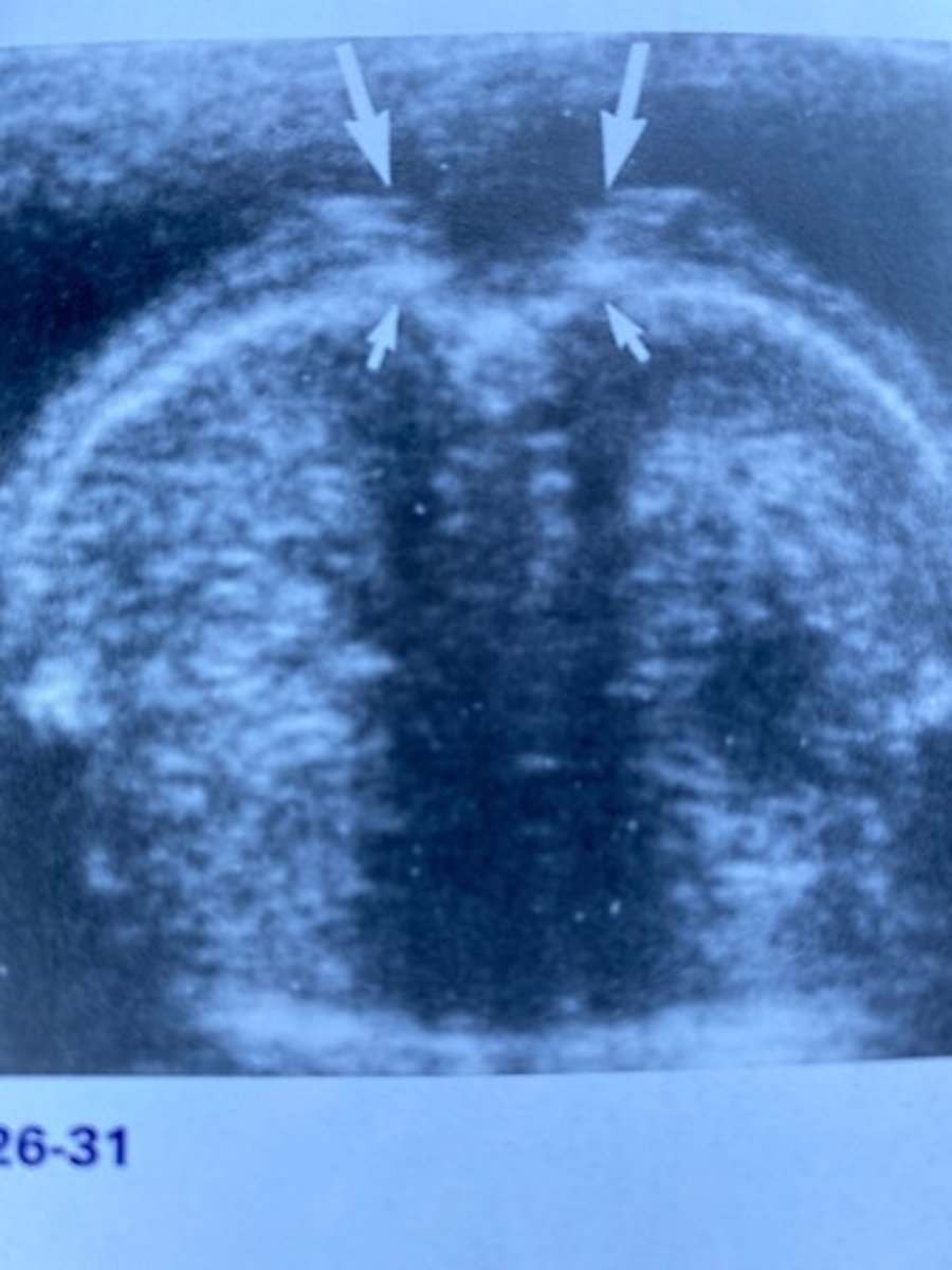 <p>What cranial finding would be least likely associated with Figure 26-31?</p><p>a. Colpocephaly</p><p>b. Hydrocephalus</p><p>c. Enlarged cisterna magna</p><p>d. Flattened frontal bones</p>