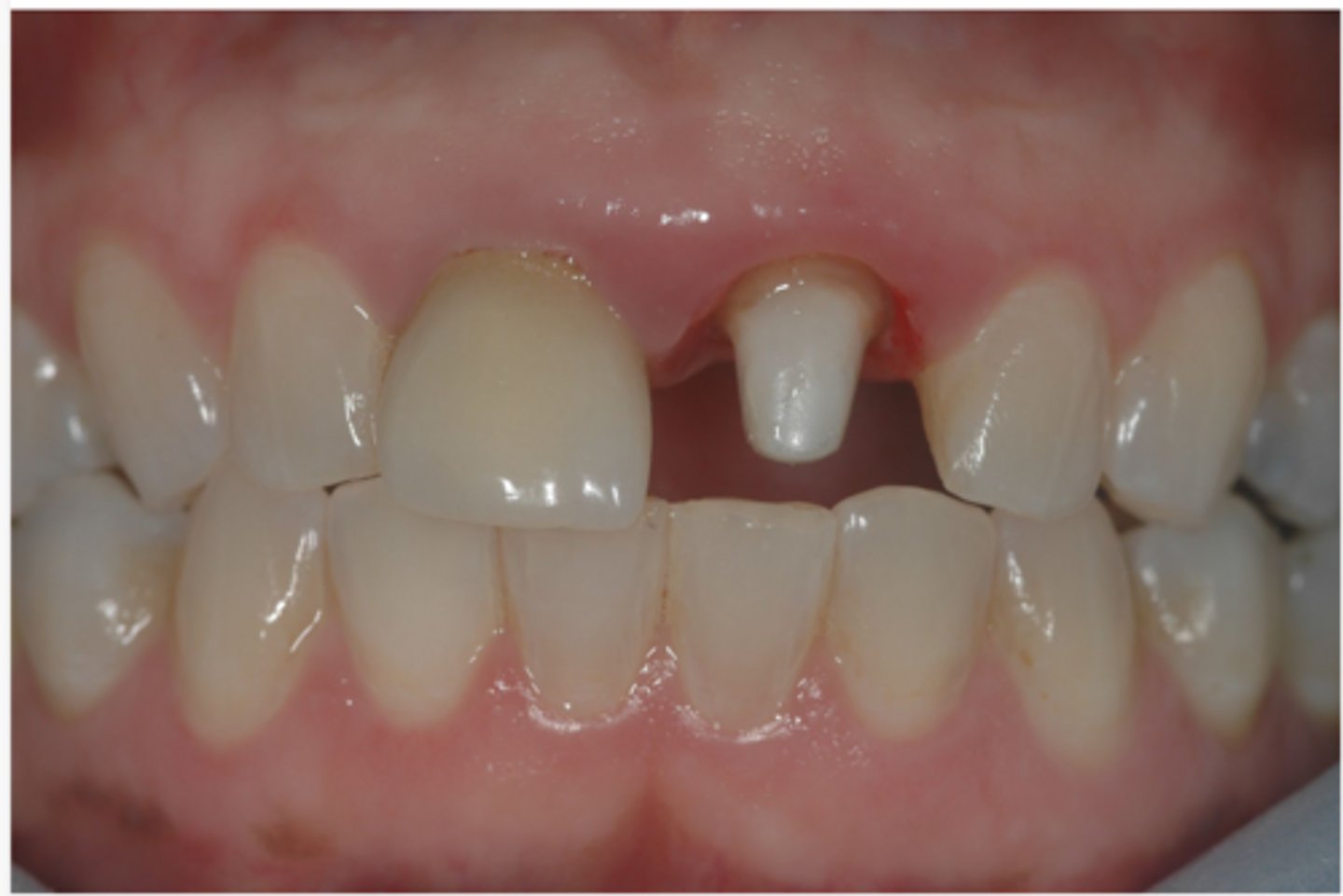 <p>Which of the four factors determining criteria for success of a provisional crown are you most concerned for here?</p>