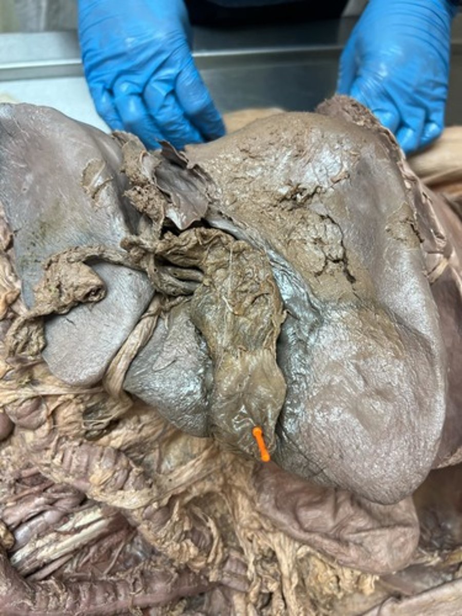 <p>fundus of gallblader</p>