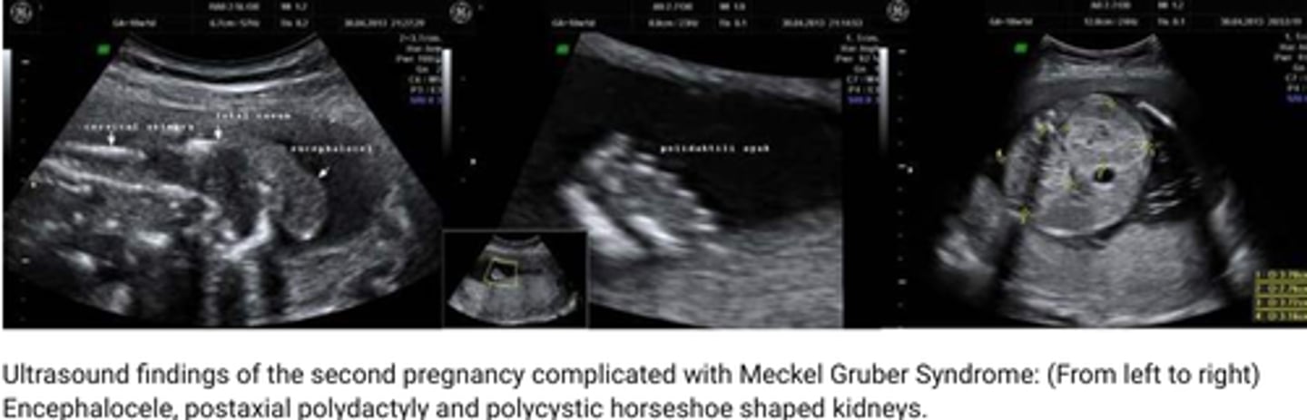 <p>Meckel-Gruber syndrome</p>