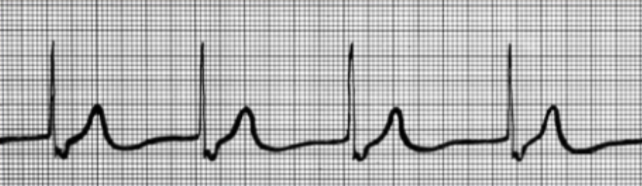 <p>Sinoatrial node nonfunctional. P-waves absent, 40-60 BPM</p>