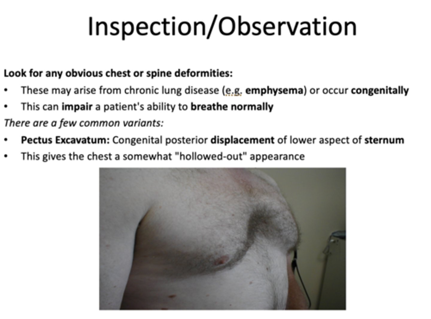 <p>Pectus Excavatum</p>