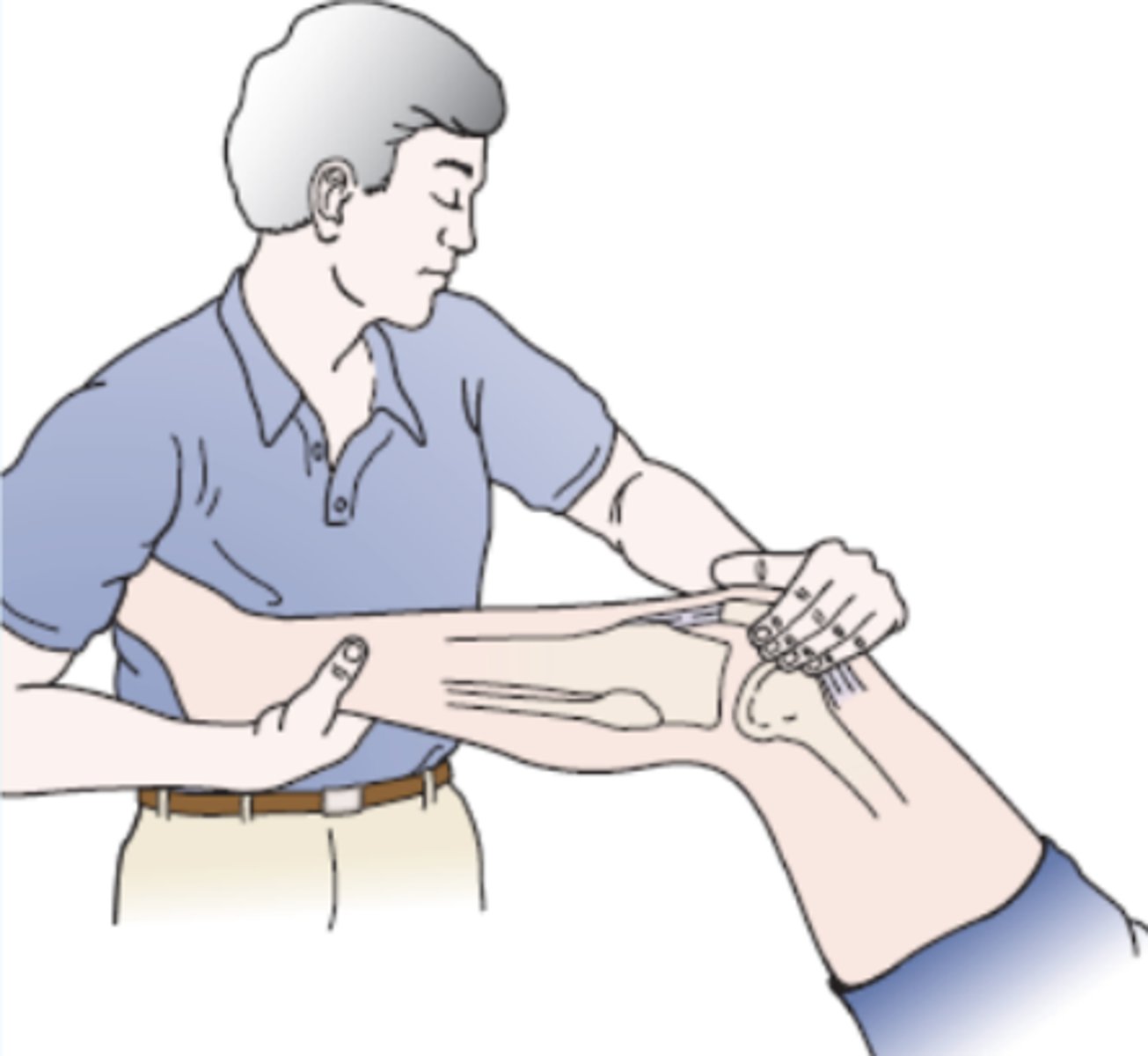 <p>- identify dysfunction of plica</p><p>Procedure:</p><p>- The patient lies in the supine position, and the examiner flexes the knee and medially rotates the tibia with one arm and hand while pressing the patella medially with the heel of the other hand and palpating the medial femoral condyle with the fingers of the same hand</p><p>(+): The patient's knee is passively flexed and extended while the examiner feels for "popping" of the plica band under the fingers. The popping indicates a positive test.</p>