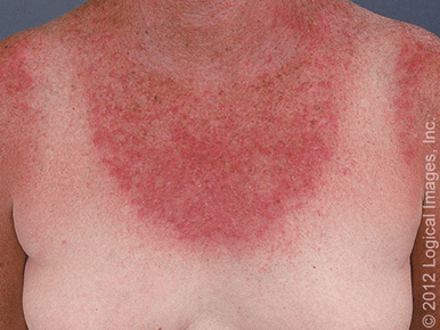 <p>rapid onset of a burning sensation that is similar to a severe sunburn - ONLY on sun-exposed skin</p>