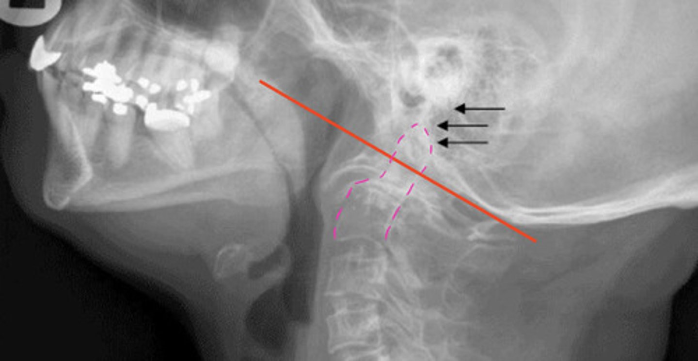 <p>Occ-C1 and/or C1-C2 facet erosions</p><p>Risk of basilar invagination and potential neurological compromise</p>