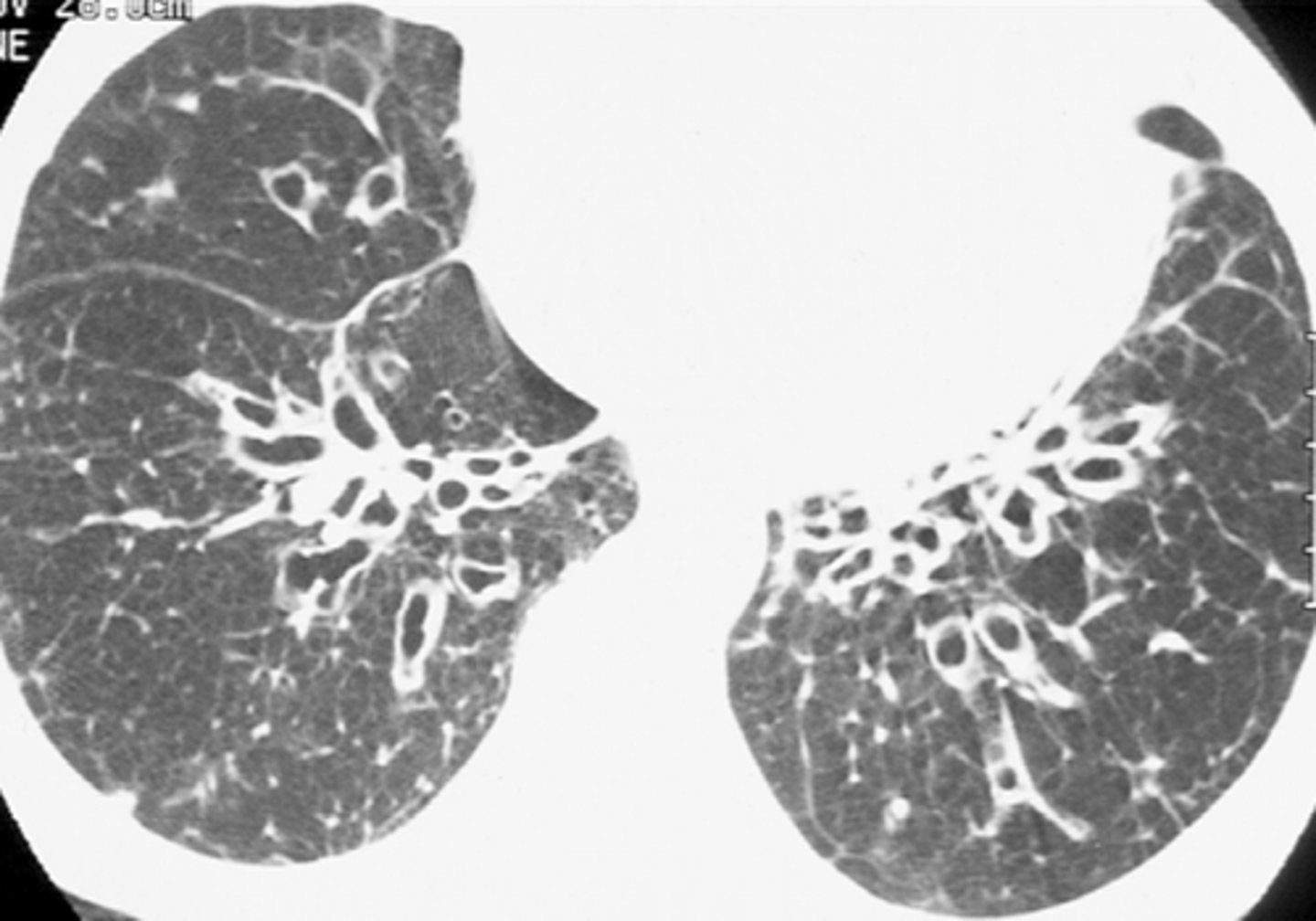 <p>abnormal dilation of the bronchi with accumulation of mucus</p>