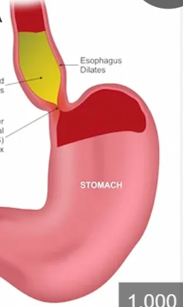 <p>FYI:  Failure of the sphincter to relax with swallowing, the esophagus has lost much of its perstaltic activity </p>