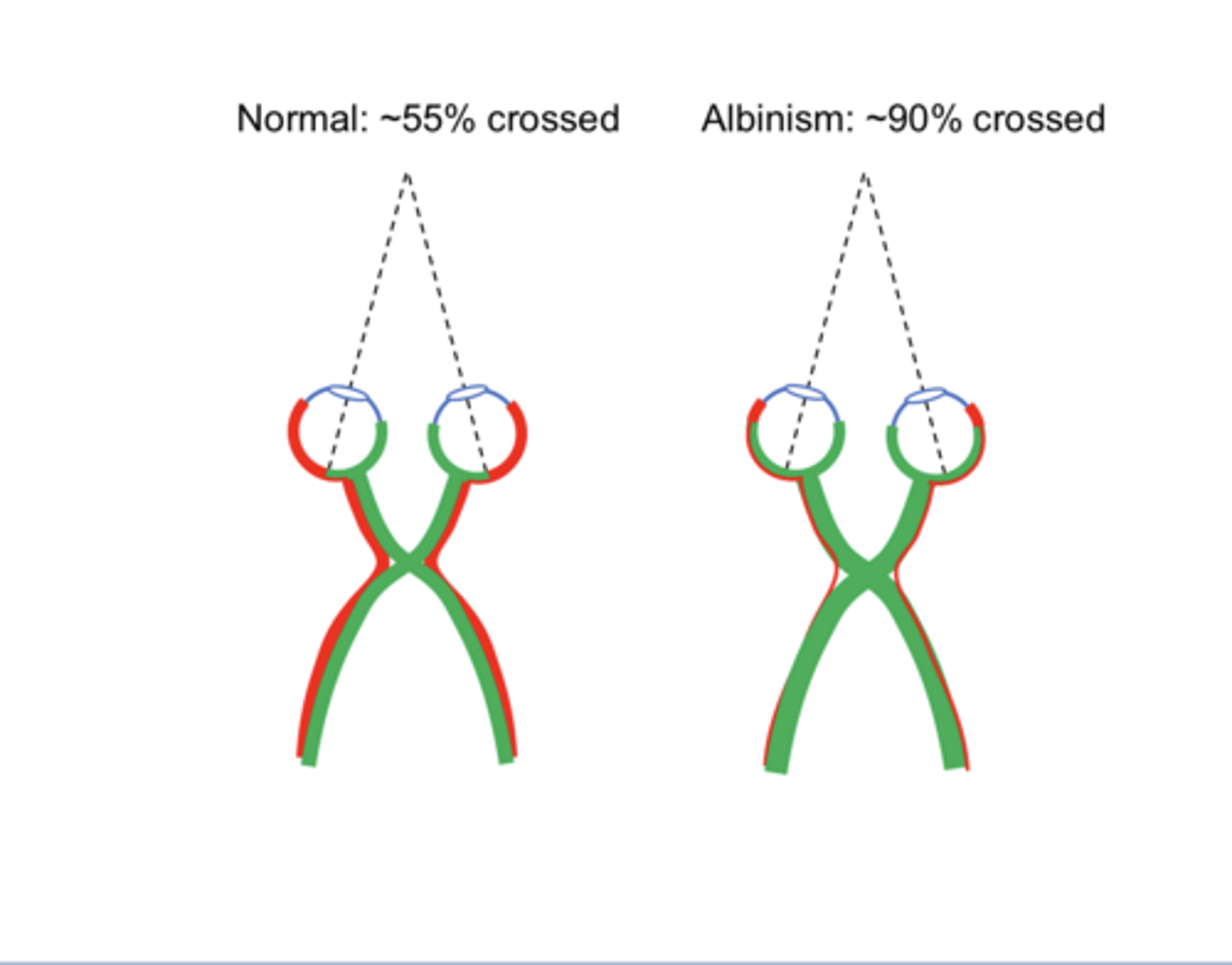 <p>Normal Crossings v Albinism Crossings at the Optic Chiasm (Pic)</p>