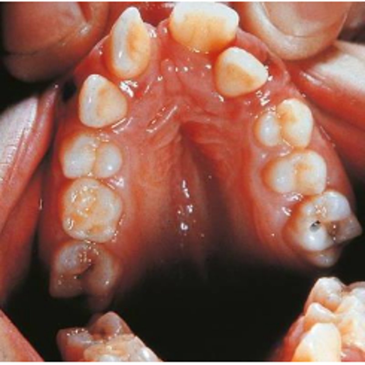 <p>1. mouth with a fishlike appearance,</p><p>2. downward sloping of the lip commissures</p><p>3. deaf because of a lack of otic ossicles (ear bones)</p>