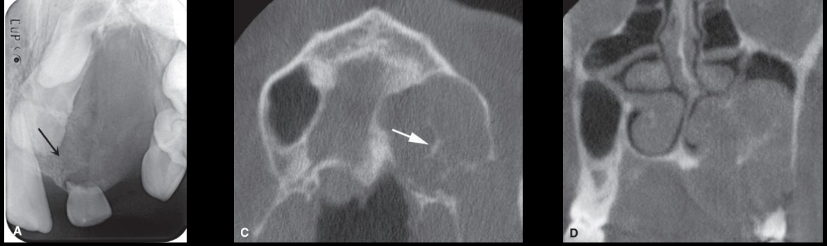 <p>Central Giant Cell Granuloma (CGCG)</p>