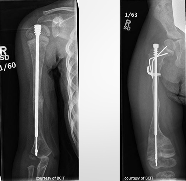 <ul><li><p>focus is to prevent fx → extendable rods in long bones </p></li><li><p>medications to reg. osteoclast formation </p></li></ul><p></p>