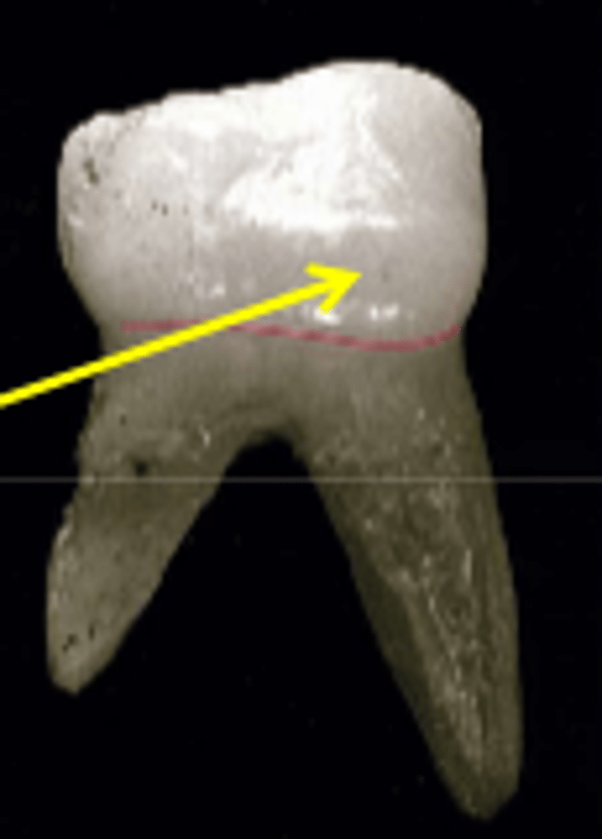 <p>bulge running mesiodistally in the cervical 3rd of the buccal surface</p>