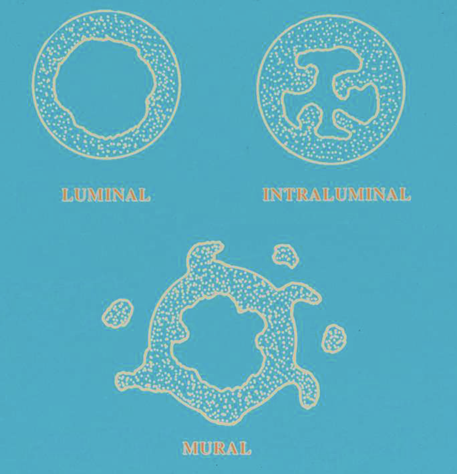 <ol><li><p>luminal: confined to luminal surface </p></li><li><p>intraluminal: tumor nodules project from lining into lumen </p></li><li><p>mural: tumor islands in wall of cyst </p></li></ol><p></p>