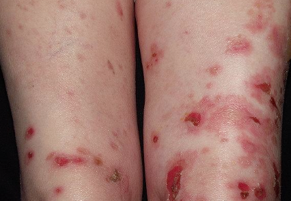 <p>What is a key FDA-approved treatment for Pemphigus Vulgaris?</p>