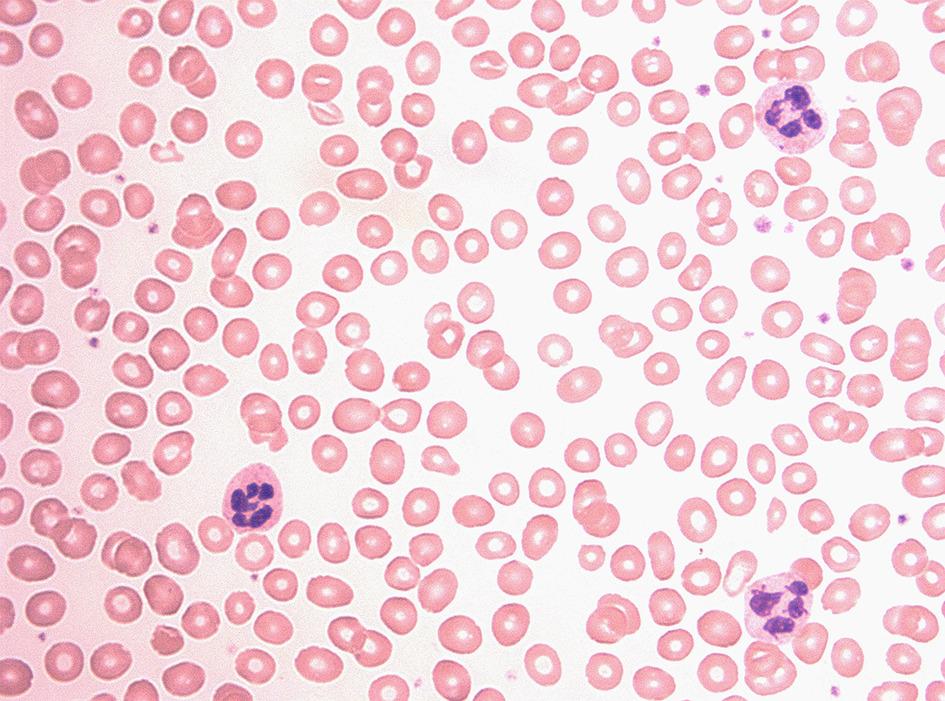 <p>Cause: decrease RBC production due to lack of Vit B12</p><p>- intrinsic factor binds to Vit B12 in parietal cells in stomach lining, protecting it from acid destruction in liver, and speeding up DNA erythropoiesis in bone marrow</p><p>-No Vit B12=unbound=takes much longer in DNA erythropoiesis</p><p>-clump <u>not</u> clot</p><p>-megaloblastic</p>