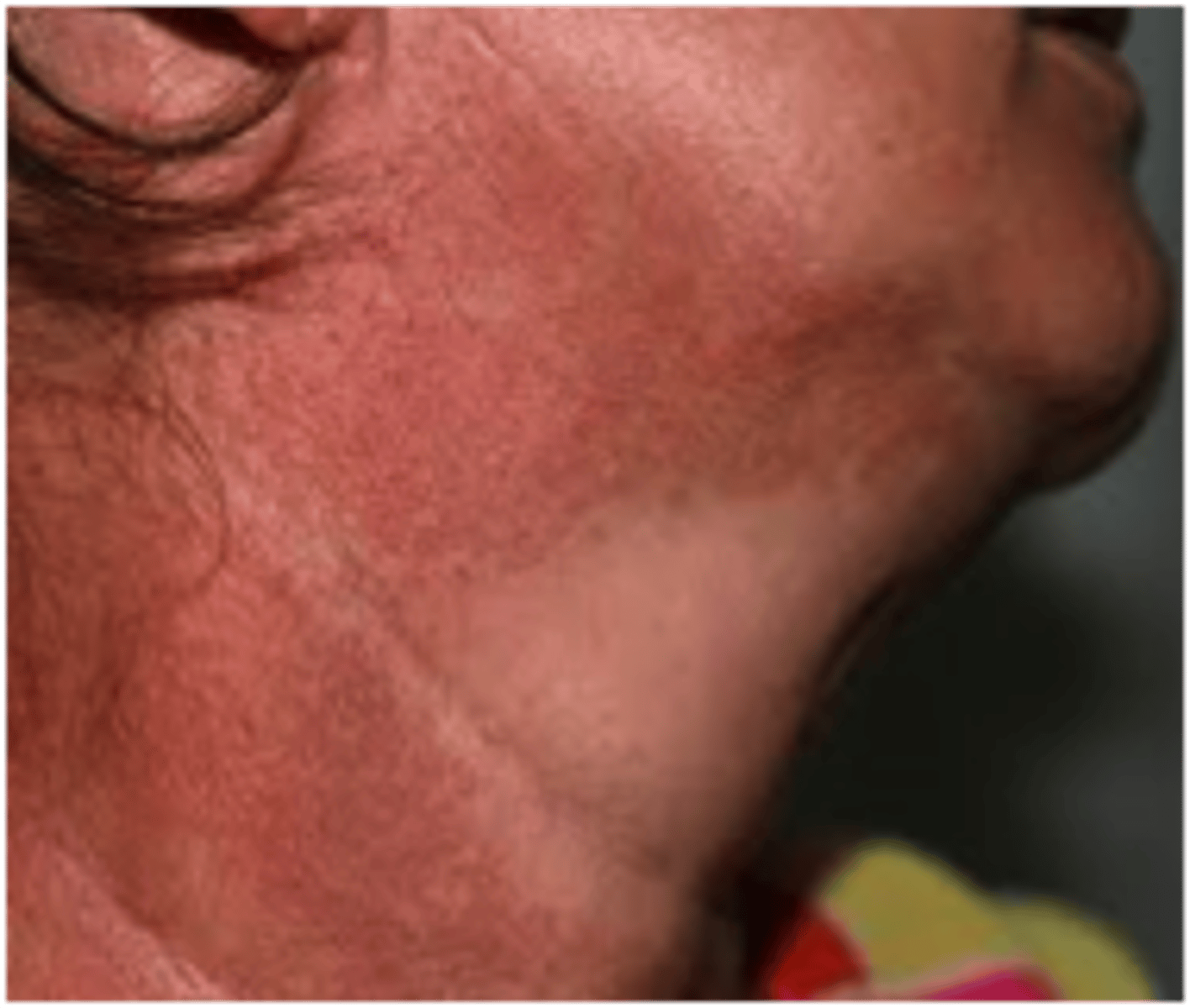<p>Red patches of skin in sun-damaged areas, especially the V of the neck and lateral neck</p><p>Often presents with fine telangectasias and hypo and hyperpigmentation</p>