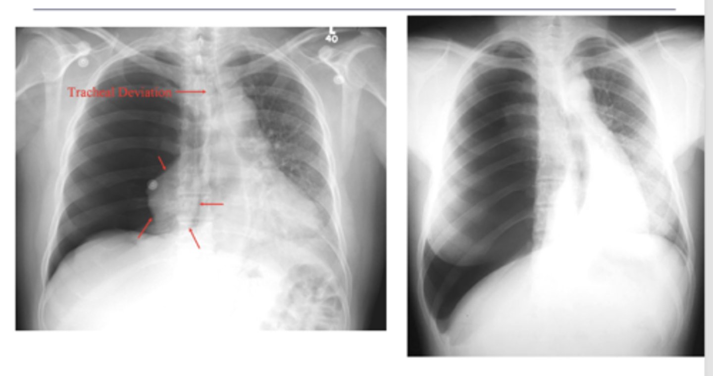 <p>What is the main radiologic finding that differentiates tension and non-tension pneumothorax?</p>
