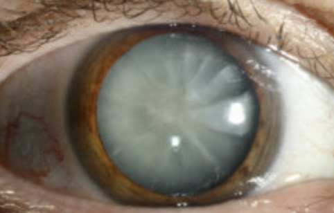 <p>One of the 4 Lens Abnormalities</p><ul><li><p>Appear<strong> gray </strong>when seen with a <strong>flashlight</strong></p></li><li><p>Appear as a <strong>black spot </strong>against the <strong>red reflex</strong> when seen through an <strong>opthalmoscope</strong></p></li></ul><p></p>