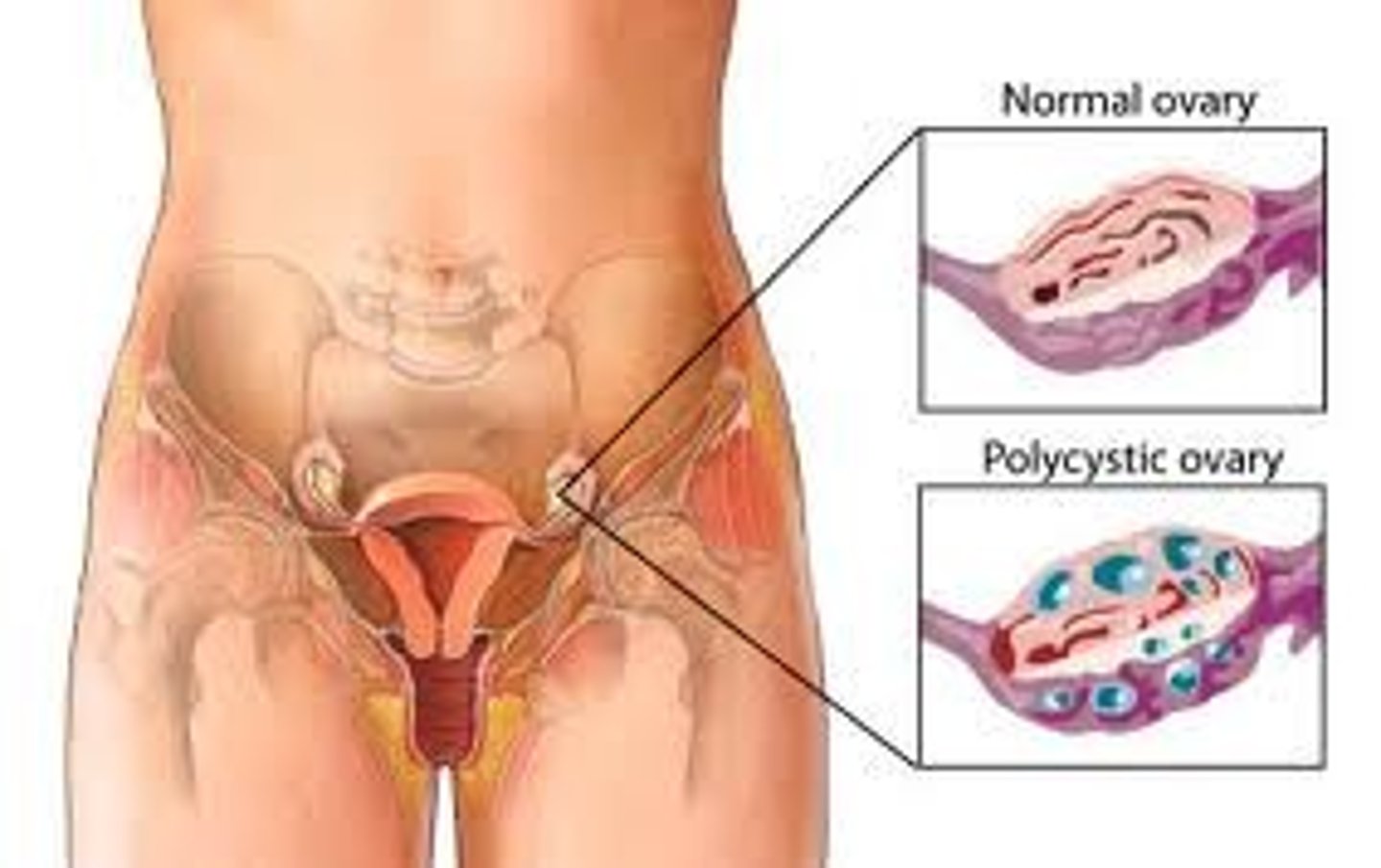 <p>condition typically characterized by hormonal imbalances, ovulatory dysfunction, and multiple ovarian cysts</p>