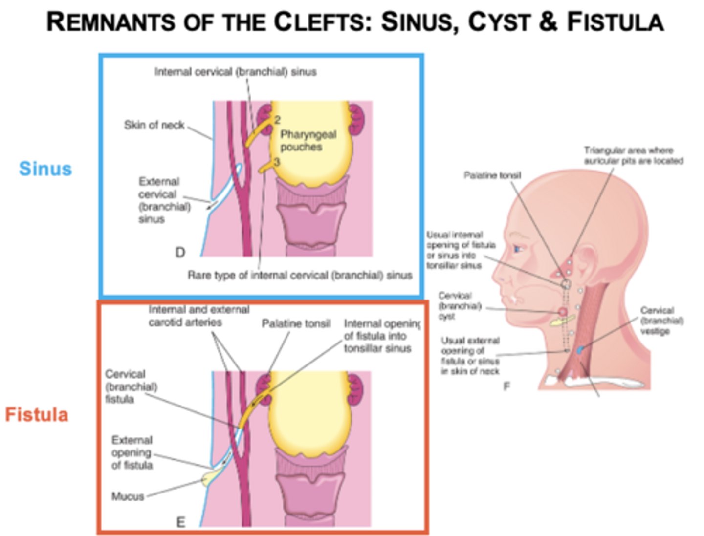 <p>Sinus, cyst, or fistula.</p>