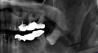 <p>Where are odontogenic keratocyst commonly found?</p>