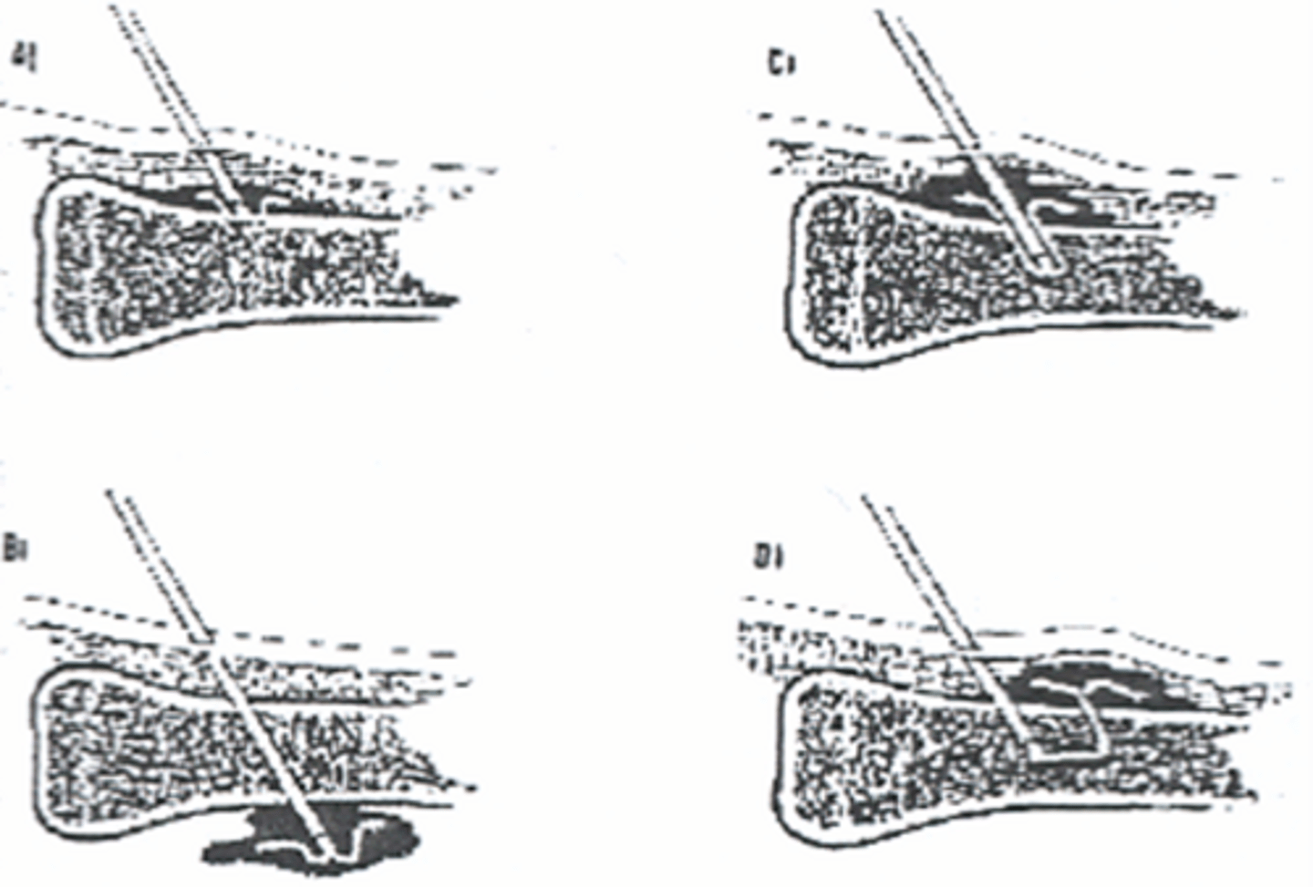 <p>Placement confirmed when marrow is withdrawn, or free flow of intravenous fluid with no evidence of soft tissue extravasation.</p>