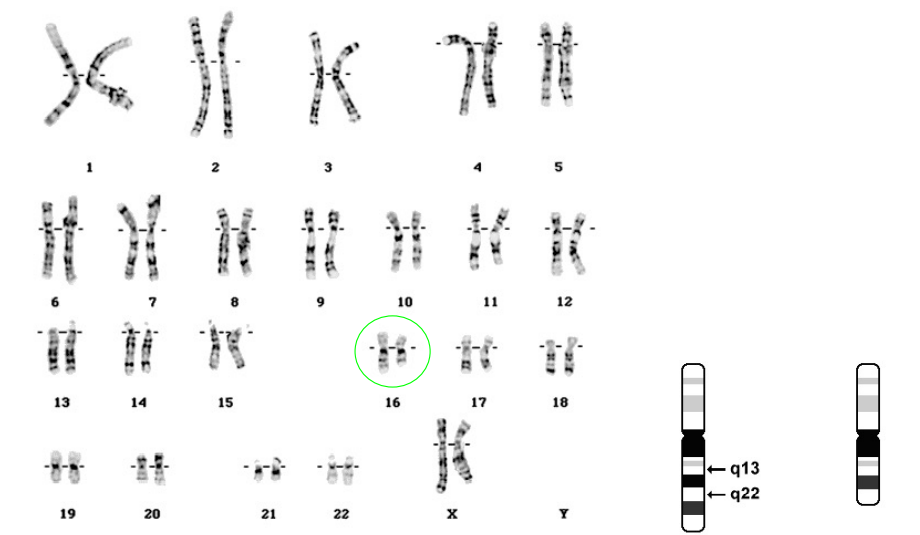 Quelle est l’anomalie associée à ce caryotype ? 