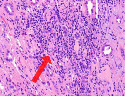 <p>mitä kuvassa näkyy? (vinkki: onkosytooma)</p>