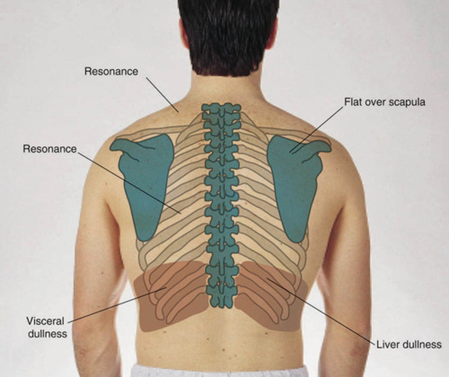 <p>sounds over lung tissue should be <span style="text-decoration:underline">resonant</span> b/l</p><p></p><p>hyperresonance = overinflation (e.g. emphysema)</p>