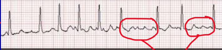 <p>What rhythm is present on the ECG below?</p>