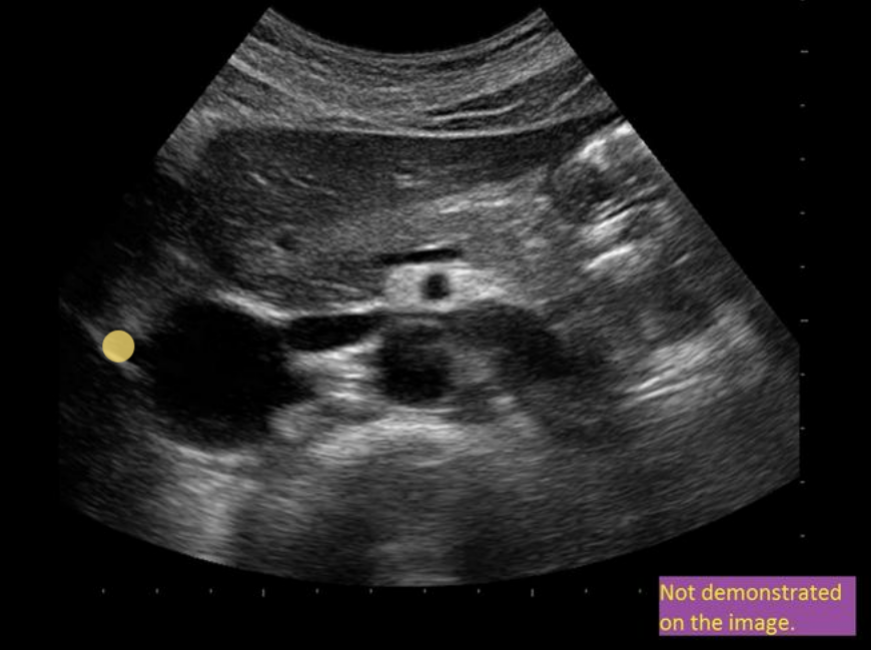 <p>has to be on the IVC</p>