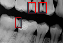 <p>Areas on a radiograph where teeth appear to overlap due to improper horizontal angulation.</p>