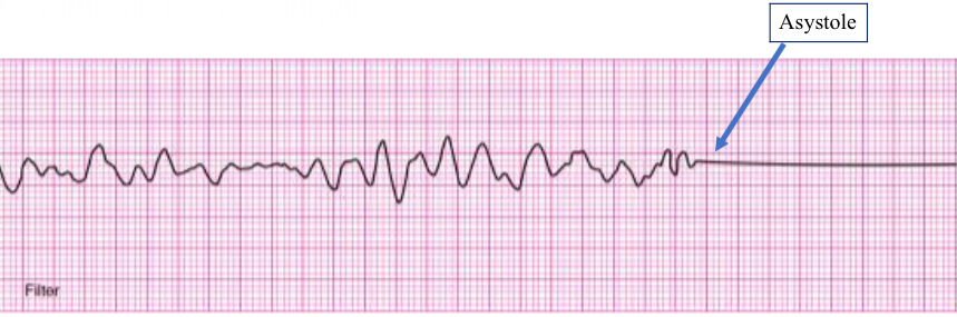 <p>irregular quivering of ventricle/myocardium</p><p>result: no CO</p><p>rhythm: irregular w/o discernible P wave, QRS complex, T wave</p><p>pt has no pulse</p><p><strong>medical emergency</strong>, requires <strong>immediate CPR and defibrillation </strong></p>