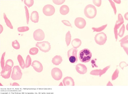 <ul><li><p>a genetic disorder </p><ul><li><p>autosomal recessive condition. </p></li></ul></li><li><p>Under certain conditions, RBCs that are normal in shape will sickle and this will cause them to get stuck in capillaries. </p></li><li><p></p></li><li><p>Symptoms/episodes that occur </p><ul><li><p>joint and chest pain</p></li><li><p>numbness in the hands and feet</p></li><li><p>jaundice</p></li><li><p>frequent infections</p></li><li><p>sores on the skin</p></li><li><p>delayed growth</p></li><li><p>stroke</p></li><li><p>seizures</p></li><li><p>breathing difficulties</p></li><li><p>Retina damage</p><ul><li><p>causes vision problems, </p></li></ul></li><li><p>damage to </p><ul><li><p>spleen</p></li><li><p>liver</p></li><li><p>kidney </p></li><li><p>lung damage </p></li></ul></li></ul></li><li><p>no cure for sickle cell disease</p></li><li><p>it can be treated or managed with </p><ul><li><p>antibiotics</p></li><li><p>blood transfusions</p></li><li><p>pain medications</p></li><li><p>bone marrow transplants</p></li><li><p>supplemental oxygen</p></li><li><p>medications to promote the development of normal hemoglobin.</p></li></ul></li></ul><p></p>