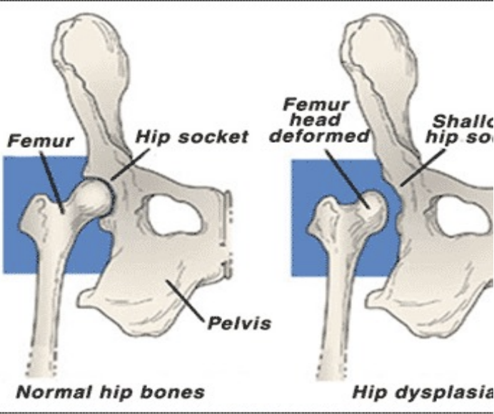 <p>Hip Dysplasia </p>